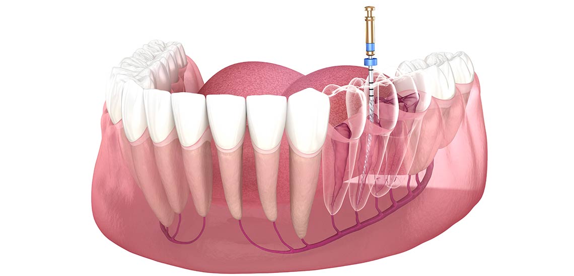 Dentures