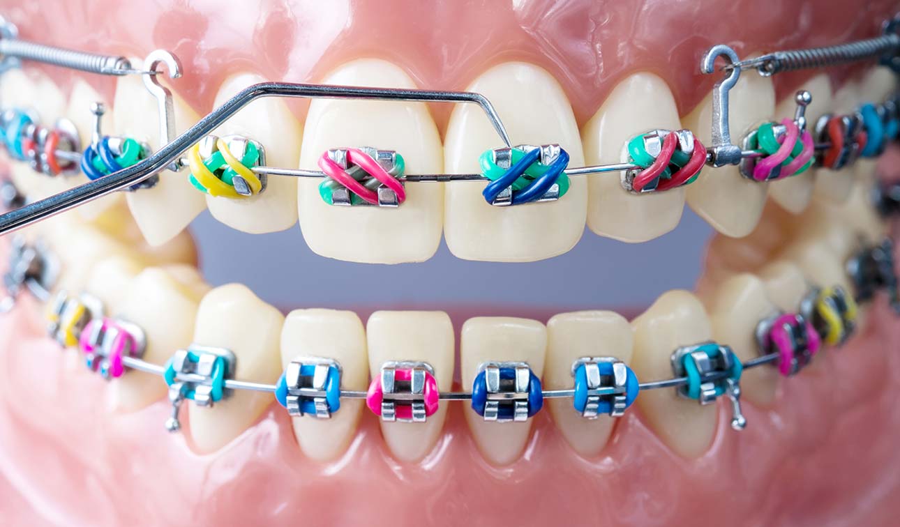 Arch Braces And How They Work